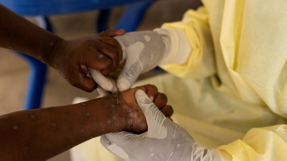 US Donates Mpox Vaccines to Nigeria